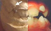 Kieferformer für Zahnreihe und gegen Rückbiss