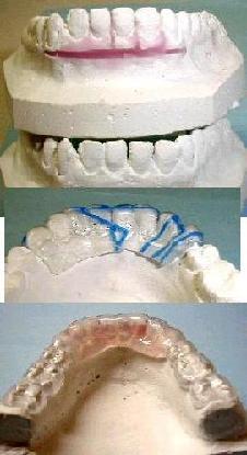 Silikon in Aligner-Schiene mit Setup-Technik